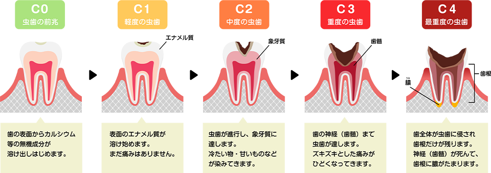 むし歯の進行