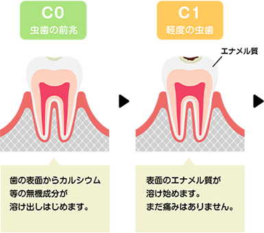 むし歯の進行1