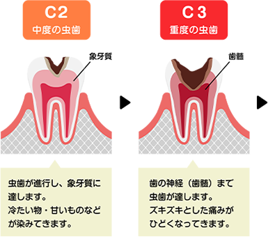 むし歯の進行2