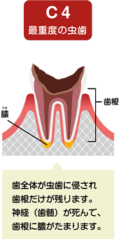 むし歯の進行3