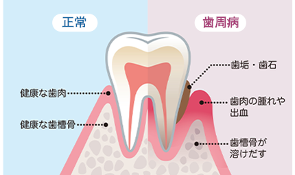 歯周病の原因