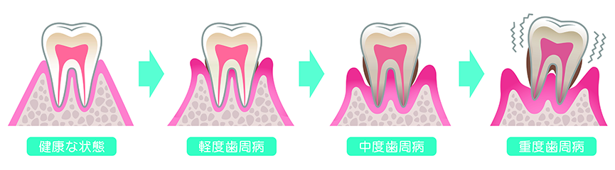 歯周病の進行