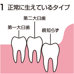 真っ直ぐ生えている親知らず