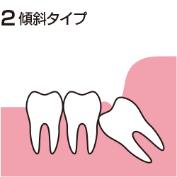 歯茎に半分埋まっている親知らず