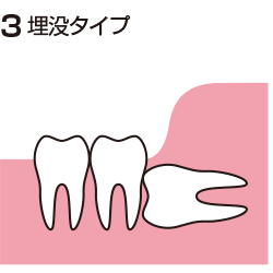 歯茎に完全に埋まっている親知らず